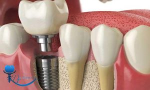 هزینه ایمپلنت دندان چگونه محاسبه می ‌شود