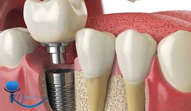 هزینه ایمپلنت دندان چگونه محاسبه می ‌شود
