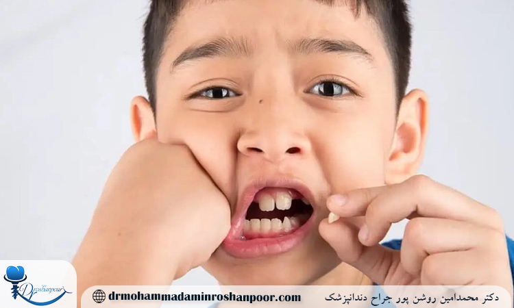 سن مناسب برای کاشت ایمپلنت دندان در نوجوانان