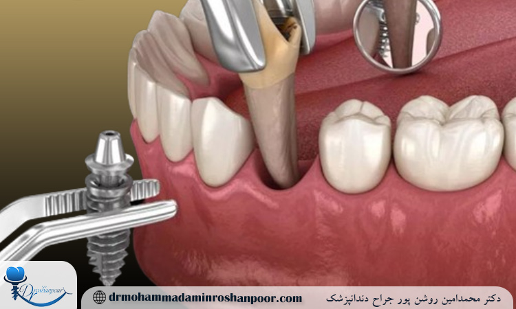 چه کسانی نباید ایمپلنت دندانی انجام دهند؟