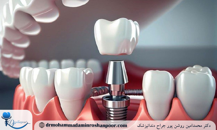 چه زمانی نباید ایمپلنت انجام داد؟ 2 آیا ایمپلنت دندانی در دوران بارداری مناسب است؟