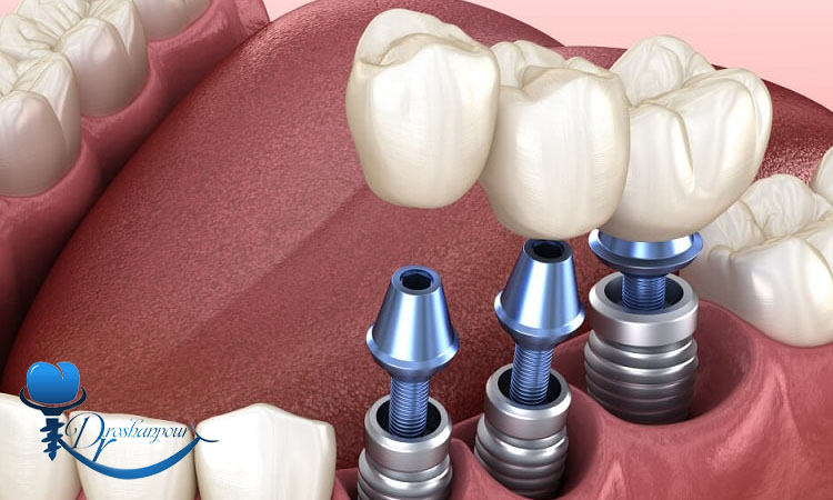 چگونه از پس زدن ایمپلنت جلوگیری کنیم؟ 1 انتخاب مواد ایمپلنت مناسب