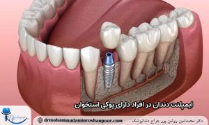 ایمپلنت دندان در افراد دارای پوکی استخوان