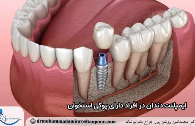 ایمپلنت دندان در افراد دارای پوکی استخوان