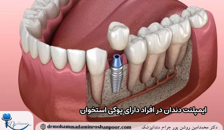 ایمپلنت دندان در افراد دارای پوکی استخوان