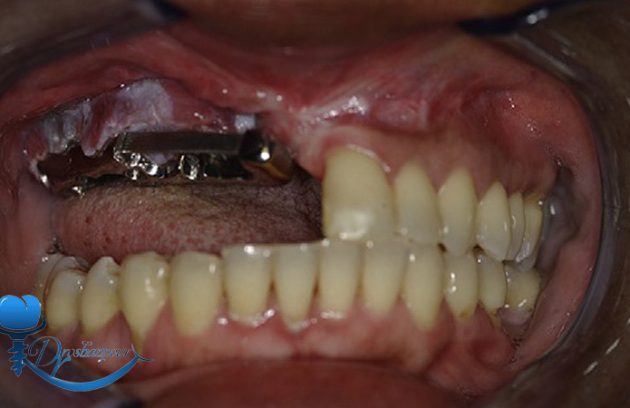 تأثیرات شیمی‌ درمانی و پیوند عضو بر ایمپلنت دندان