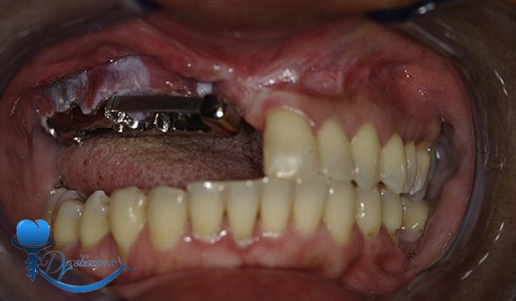 تأثیرات شیمی‌ درمانی و پیوند عضو بر ایمپلنت دندان