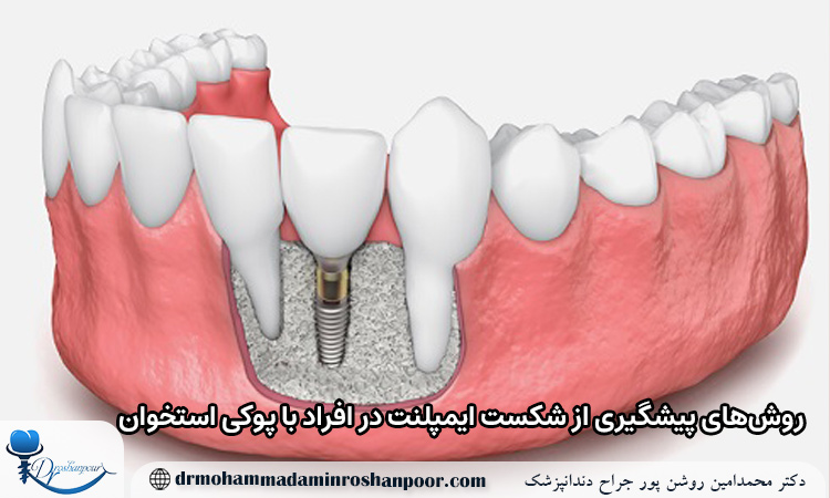 روش‌ های پیشگیری از شکست ایمپلنت در افراد با پوکی استخوان