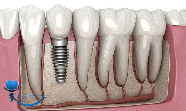 چگونه از پس زدن ایمپلنت جلوگیری کنیم؟ 2 عوامل موثر در خطر پس زدن ایمپلنت