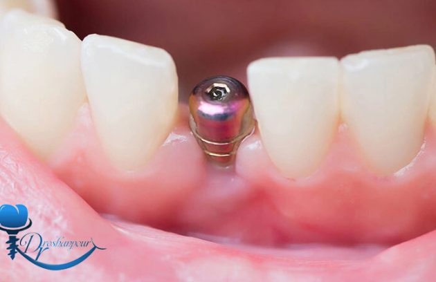 چه زمانی باید ایمپلنت دندان را تعویض کرد؟