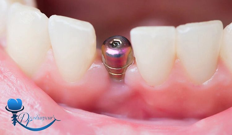 چه زمانی باید ایمپلنت دندان را تعویض کرد؟