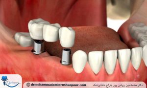 چه زمانی نباید ایمپلنت انجام داد؟