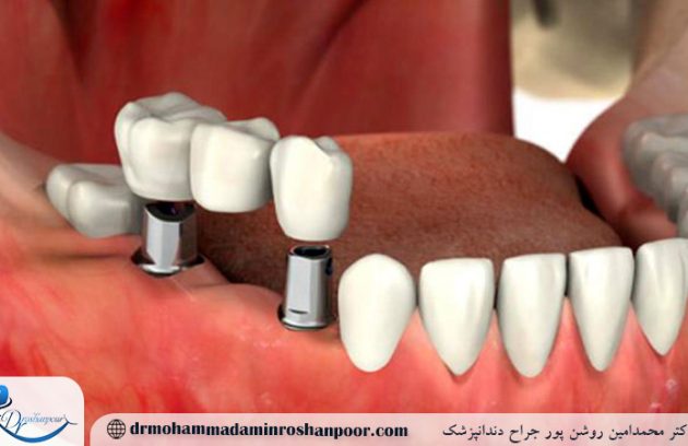 چه زمانی نباید ایمپلنت انجام داد؟