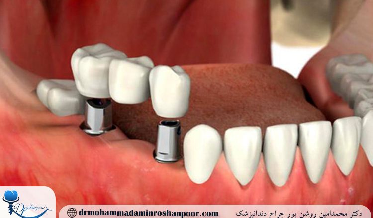 چه زمانی نباید ایمپلنت انجام داد؟