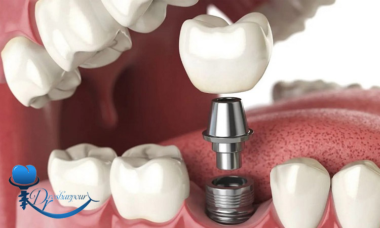 چه زمانی باید ایمپلنت دندان را تعویض کرد؟ 2 چگونه از ایمپلنت دندان برای طولانی مدت مراقبت کنیم؟