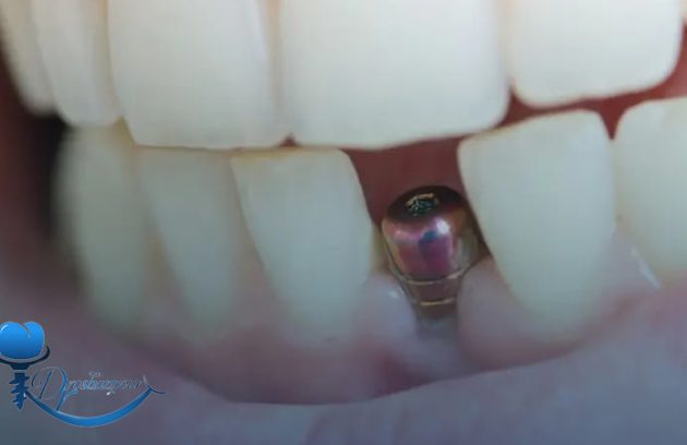 چگونه از پس زدن ایمپلنت جلوگیری کنیم؟