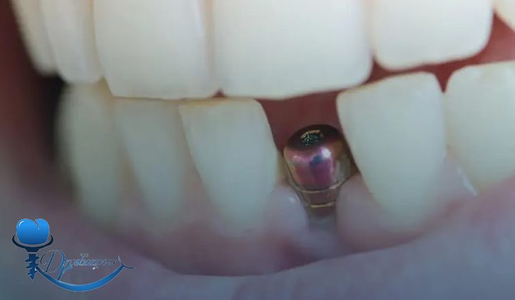 چگونه از پس زدن ایمپلنت جلوگیری کنیم؟