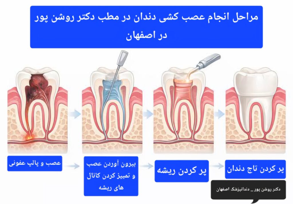 مراحل عصب کشی دندان در اصفهان
