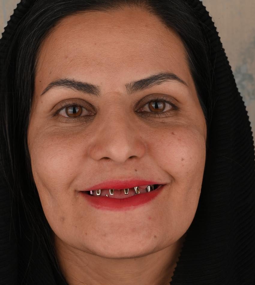 قبل از ایمپلنت کامل دو فک