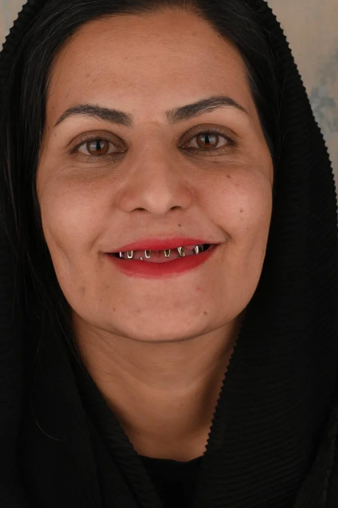 قبل از ایمپلنت کامل دو فک
