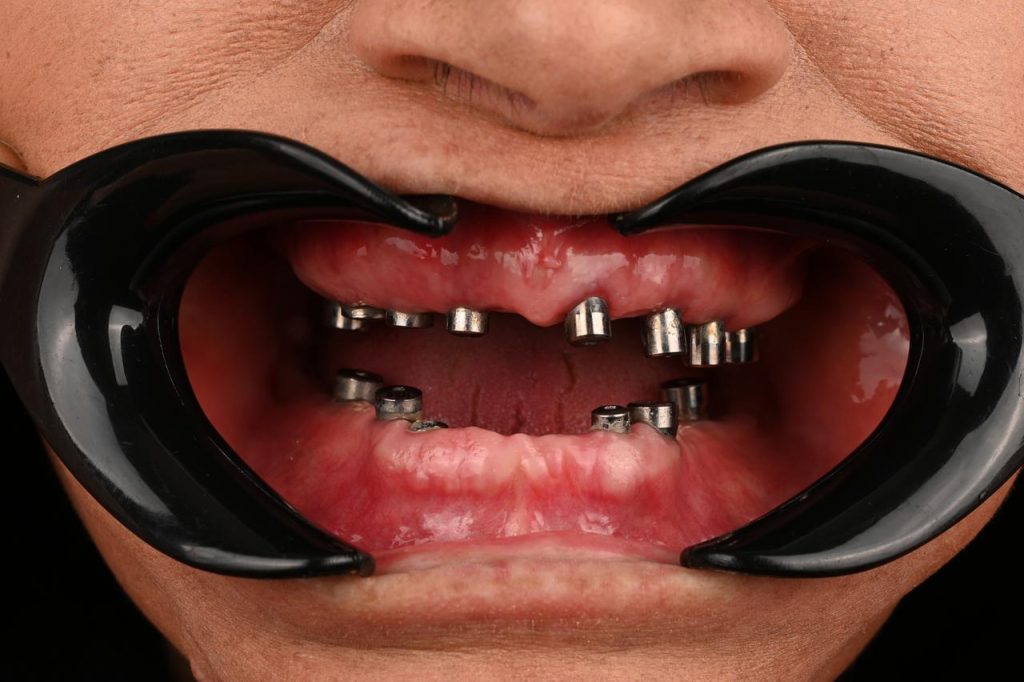 مرحله هیلینگ ایمپلنت