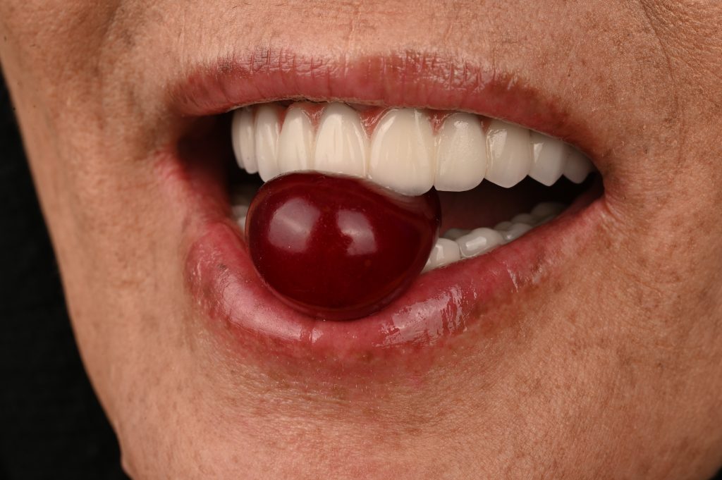 بعد از ایمپلنت