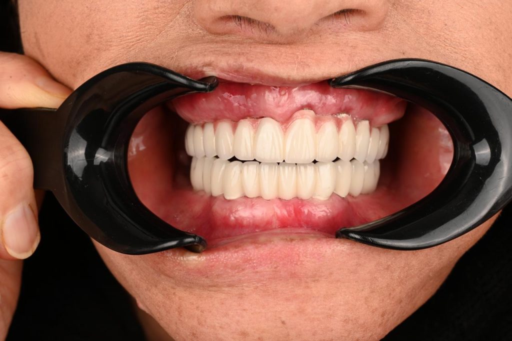 بعد از ایمپلنت کامل دو فک