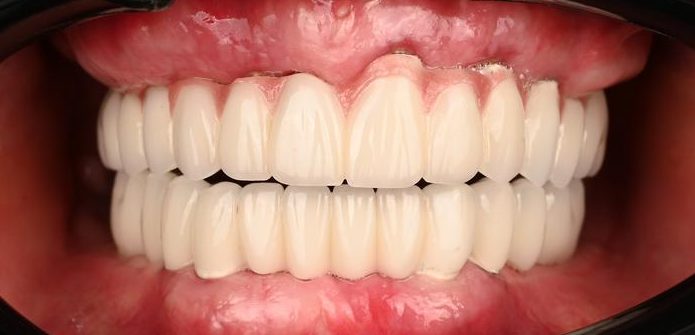 بعد از ایمپلنت کامل دو فک