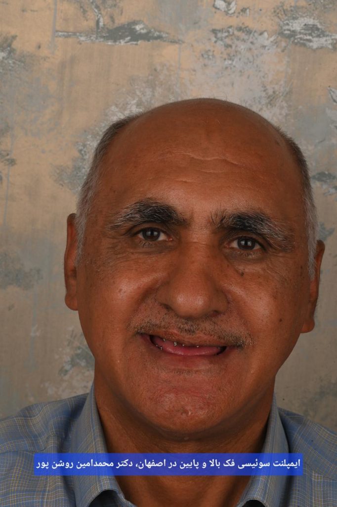 ایمپلنت سوییسی دو فک اصفهان