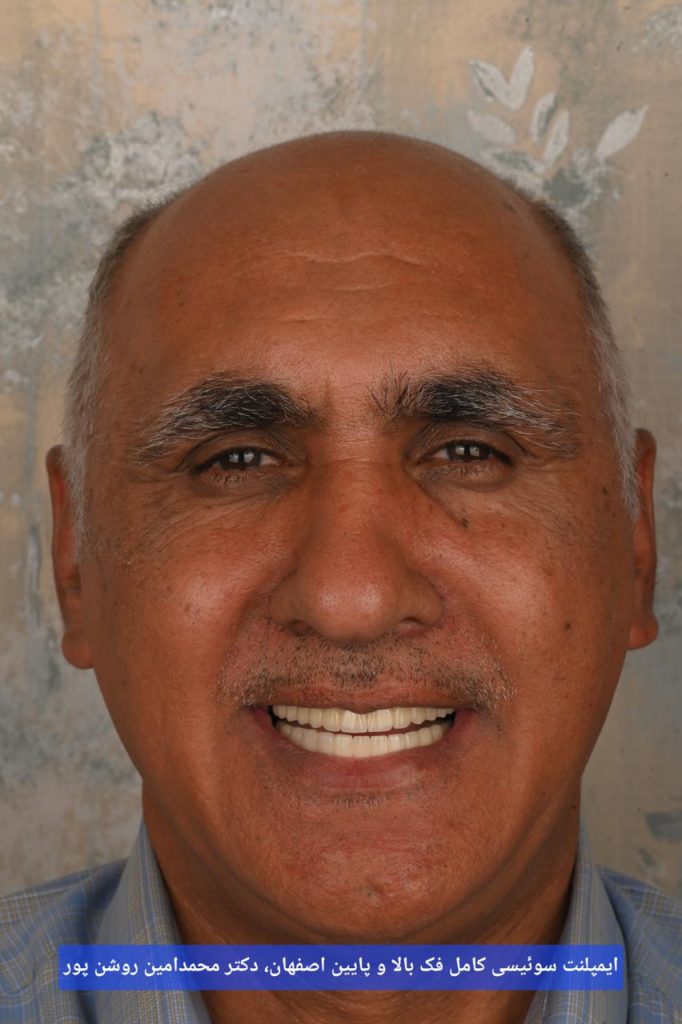 ایمپلنت سوییسی دو فک اصفهان