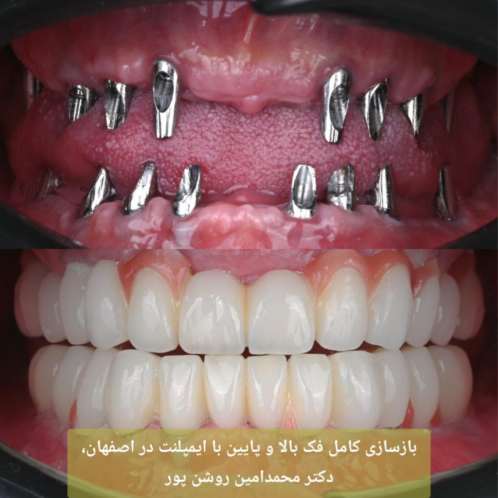 بازسازی کامل فک بالا و پایین با ایمپلنت در اصفهان دکتر محمدامین روشن پور