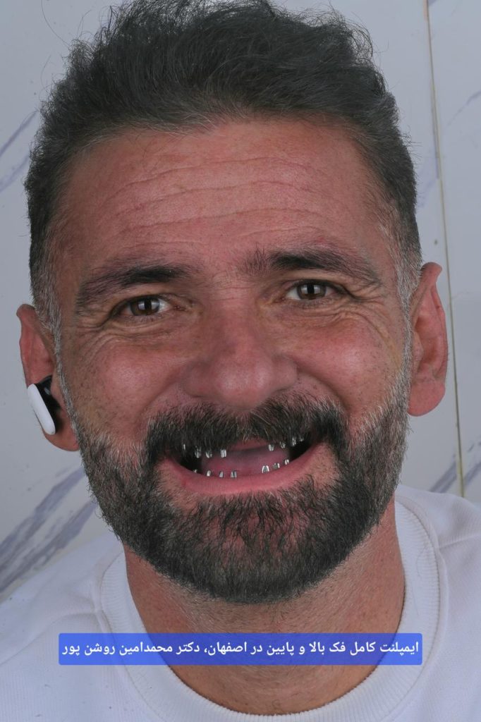 ایمپلنت کامل فک بالا و پایین در اصفهان