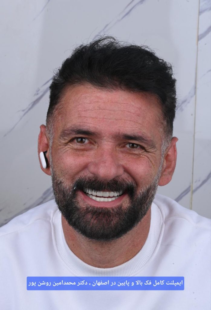 ایمپلنت کامل فک بالا و پایین در اصفهان