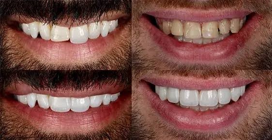 هزینه کامپوزیت دندان در اصفهان