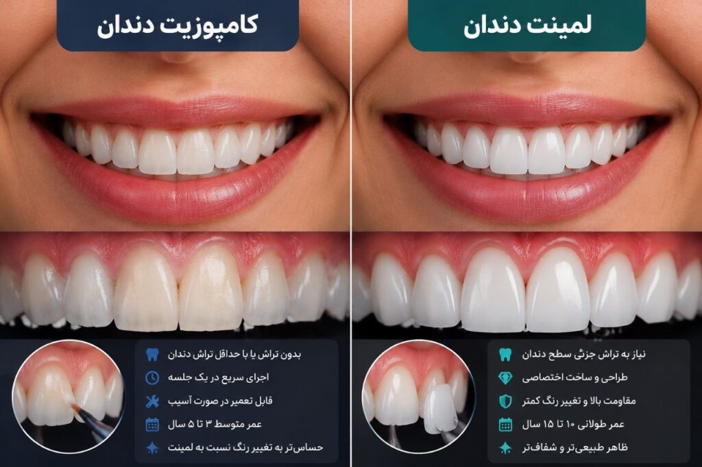 تفاوت قیمت لمینت دندان با کامپوزیت دندان