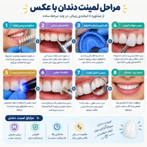 صفر تا صد مراحل لمینت دندان با عکس 