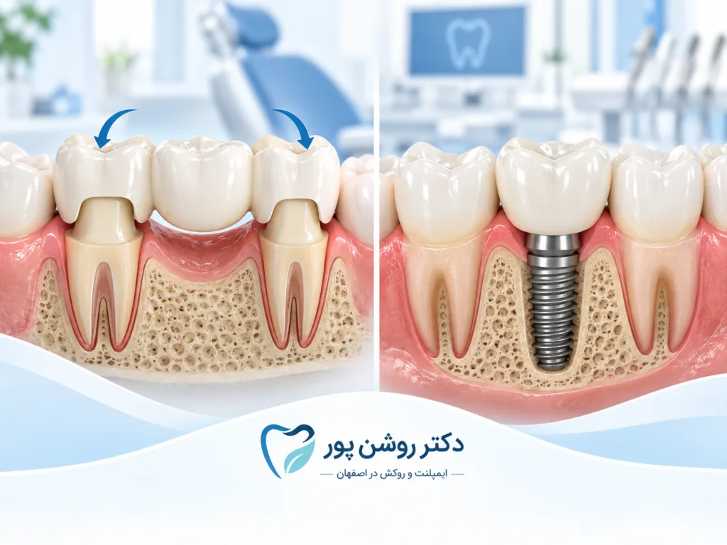 بریج دندان - جایگزینی دندان بدون ایمپلنت