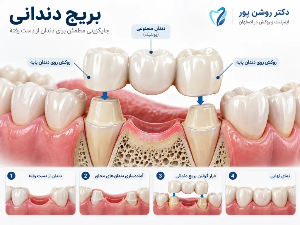 بریج دندان چیست؟