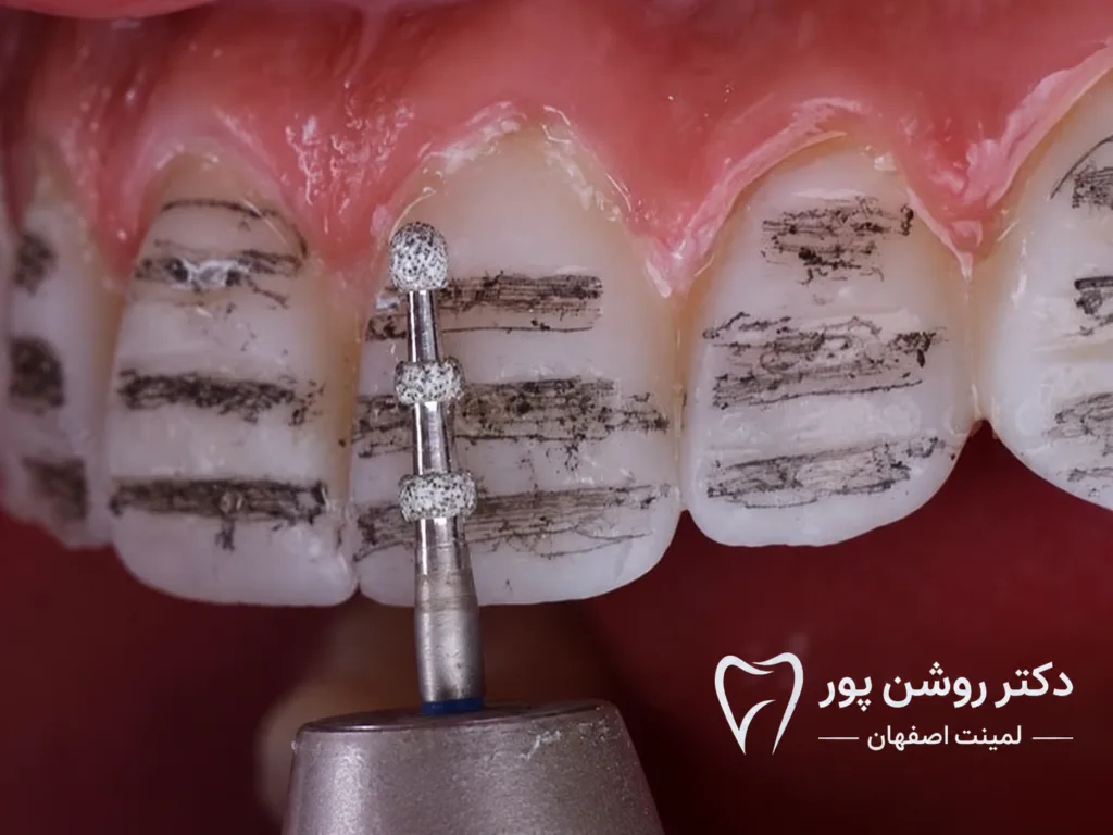 آماده سازی با حداقل تراش