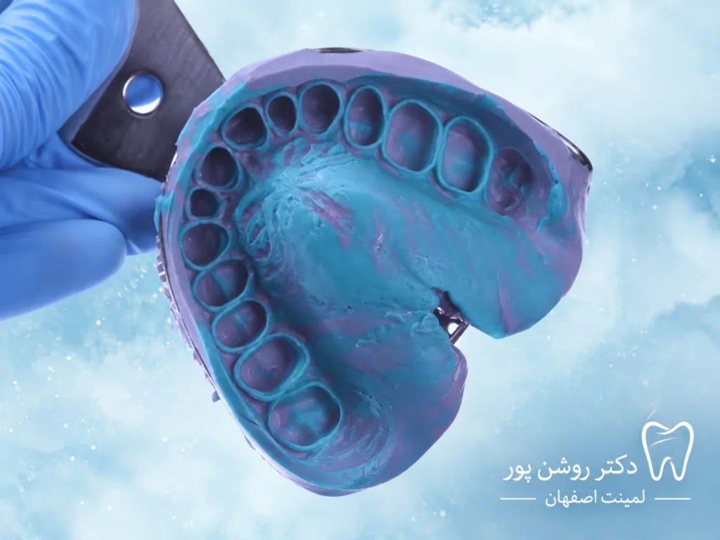 قالبگیری لمینت در اصفهان